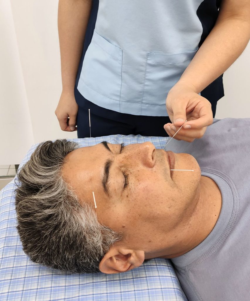 especialista aplicando acupuntura para tratamiento de parálisis facial